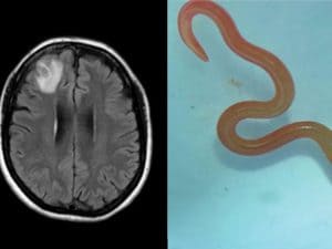 Un verme estratto vivo dal cervello di una donna: un caso raro che suscita preoccupazione