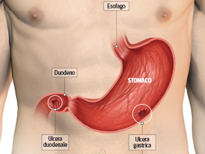 Bruce Springsteen annulla concerti di settembre a causa di un'ulcera peptica, preoccupazione per la sua salute