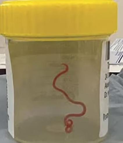 Orrore in Australia: verme di 8 centimetri estratto dal cervello di una donna afflitta da mal di testa e diarrea